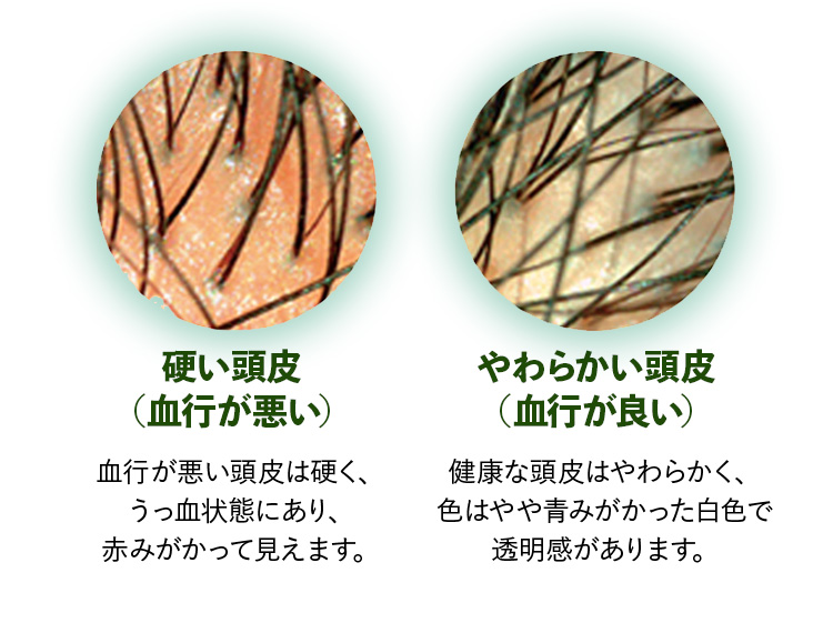 硬い頭皮（血行が悪い）血行が悪い頭皮は硬く、うっ血状態にあり、赤みがかって見えます。やわらかい頭皮（血行が良い）健康な頭皮はやわらかく、色はやや青みがかった白色で透明感があります。